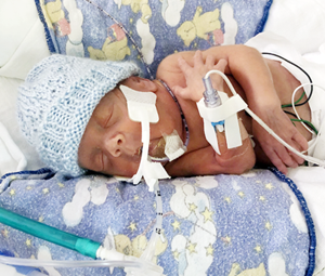 Premature baby Marcus on a TB Vets-funded ventilator, Royal Columbian Hospital